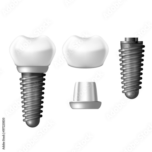 Component parts of dental implant - teeth denture