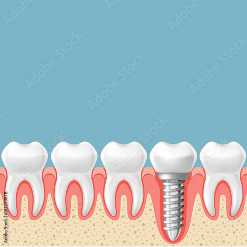 Row of teeth with dental implant - teeth prosthetics scheme, gum cut