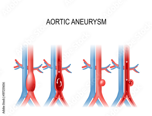 aortic aneurysm photo