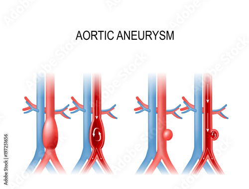 aortic aneurysm