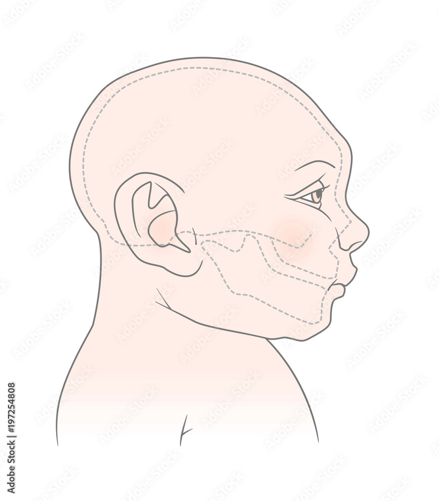Anatomical image of the head and skull of a newborn child with microcephaly of the cranium. Virus Zika. Isolated on white background Anatomical image of the head and skull of a newborn child with microcephaly of the cranium. Virus Zika. Isolated on white background