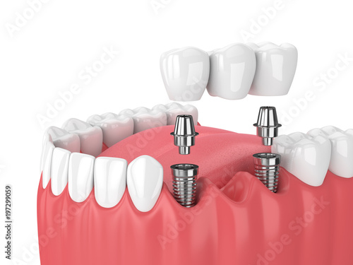 3d render of jaw and implants with dental bridge photo