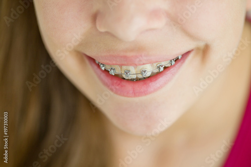 Girl with braces  