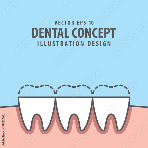 Square banner attrition (Bruxism) teeth illustration vector on blue background. Dental concept.