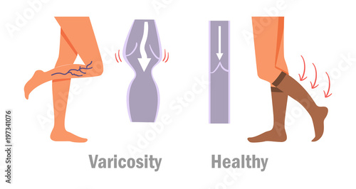 Varicosity. Legs. Vector.