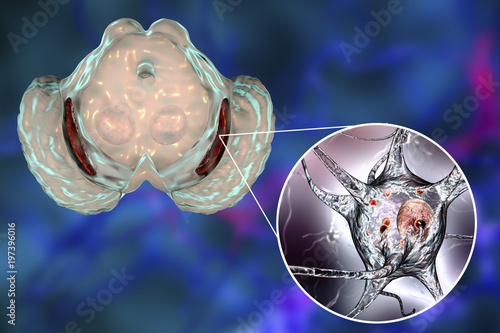 Billede på lærred Black substance, basal banglia of the midbrain, in Parkinson's disease, 3D illus