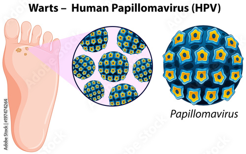 Diagram showing warts in human foot