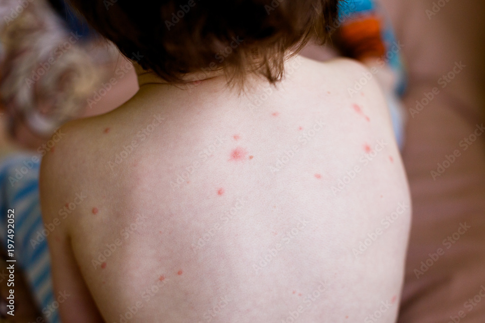 Boy with chicken pox rash. Red spots on children's skin Stock Photo