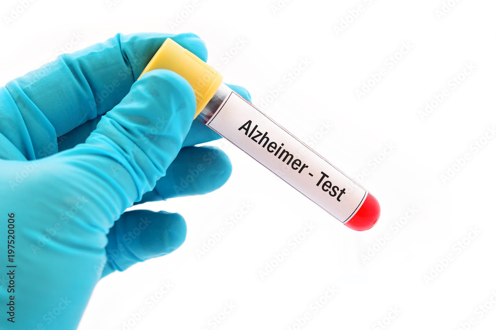 Fototapeta premium Test tube with blood sample for Alzheimer disease test 