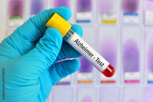 Fotografía Test tube with blood sample for Alzheimer disease test