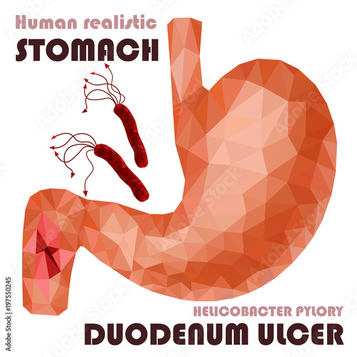 Realistic low poly human stomach and inflammation of the duodenum. Healthy stomach, ulcer duodenum diseases, helicobacter pylori bacteria virus attack.