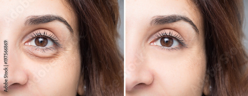 Woman face before and after blepharoplaty, eye with and without puffiness