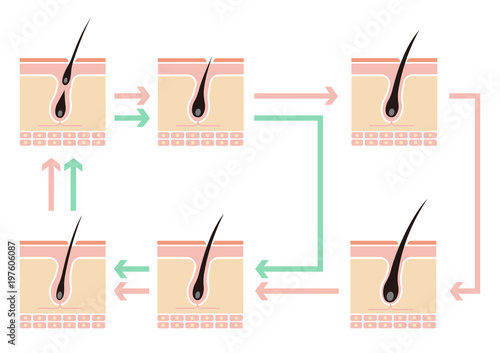 Comparative illustration of normal hair cycle and AGA ( androgenetic alopecia)/ no text. 