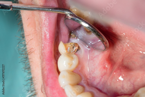 Treatment of the roots of the tooth. Sealing and cleaning a carious human tooth close-up of a macro. The concept of innovation and technology in modern endodontic