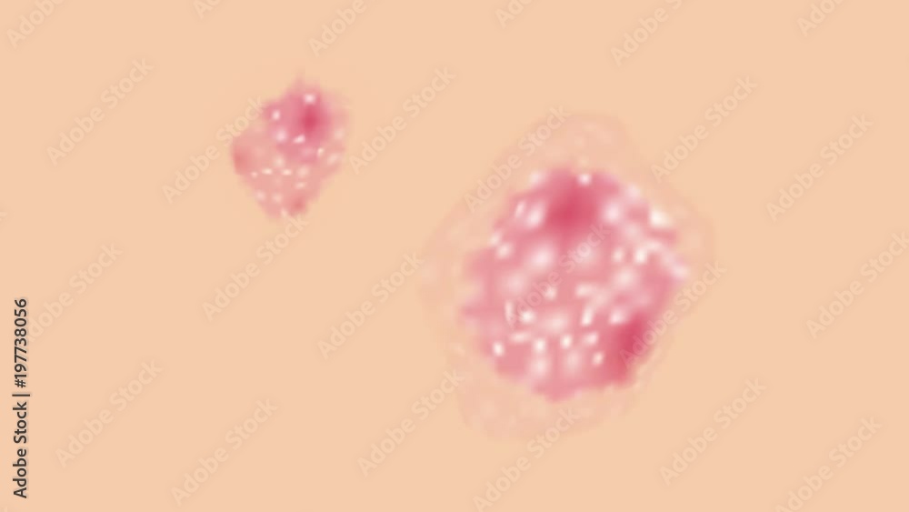 skin disease graphic animation / psoriasis , urticaria , eczema skin disease graphic animation / psoriasis , urticaria , eczema