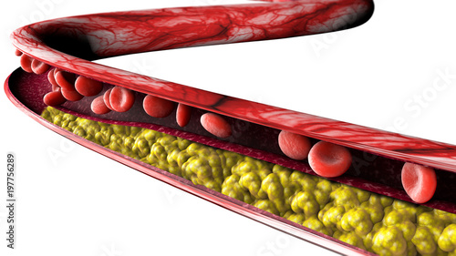 Formazione di colesterolo, grasso, arteria, cuore. Restringimento di una vena per la formazione di grasso
