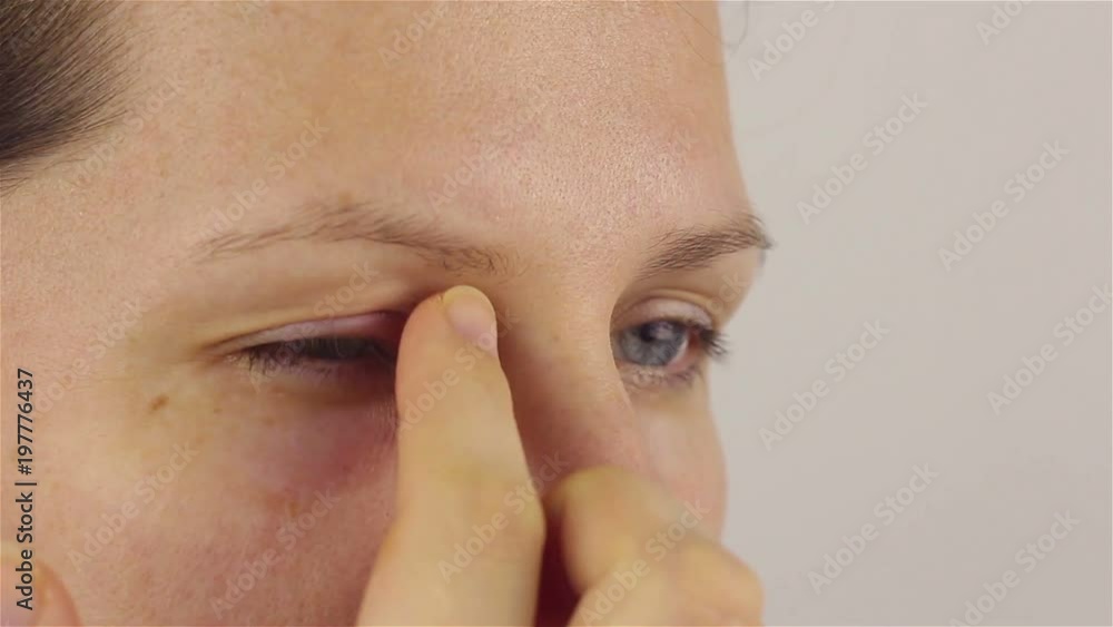 Young woman with hordeolum disease in the eye. Young woman with hordeolum disease in the eye.