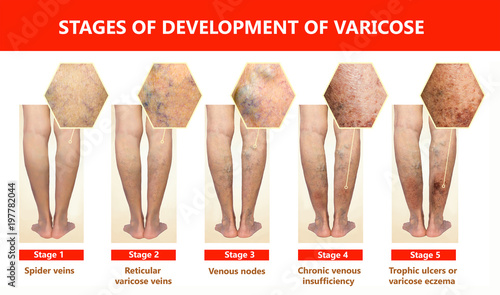 Varicose veins on a female senior leg
