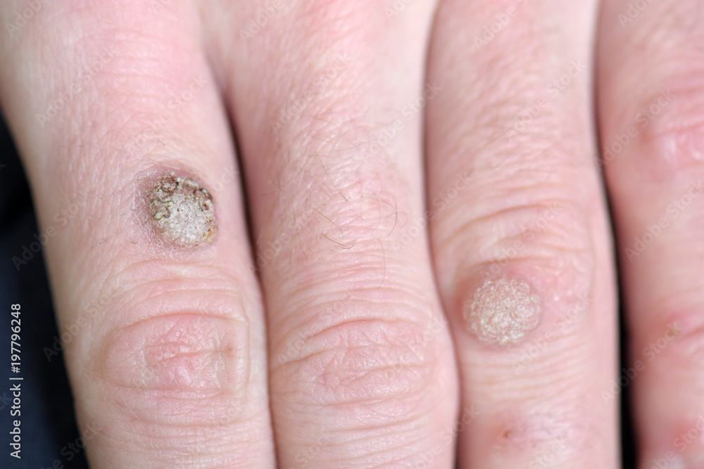 Fototapeta premium Wart on the hand finger.