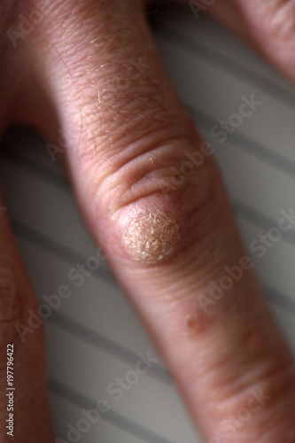 Wart on the hand finger.  © muro