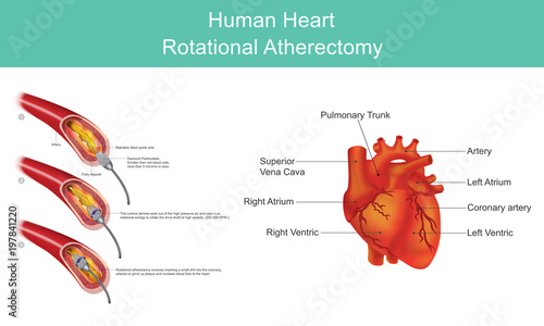 Heart Diamond Angioplasty