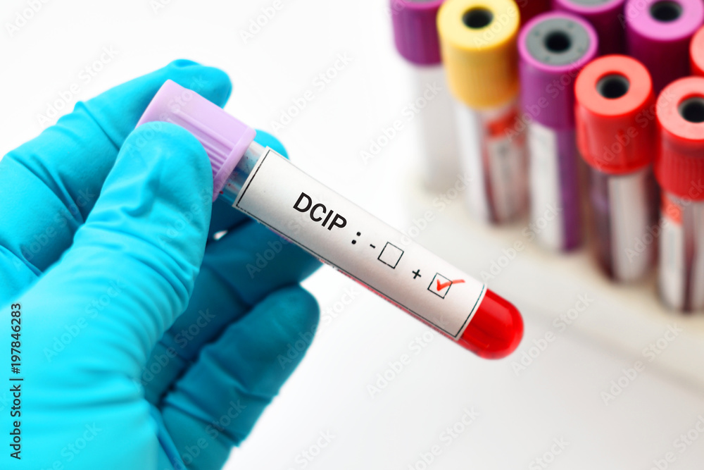 Obraz premium Blood sample positive with DCIP test, hemoglobin E thalassemia diagnosis 