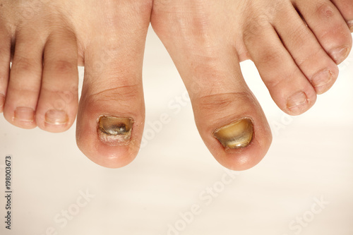fungal infections of the nails of the feet of a young woman photo
