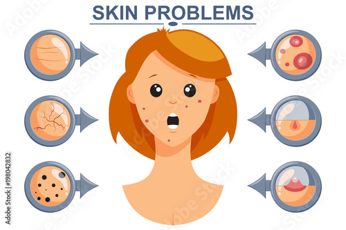 Skin problems vector infographics. Cartoon illustration of a woman face with dermatological diseases: pimple, acne, black dots.