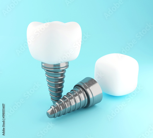 3d Dental tooth implant.