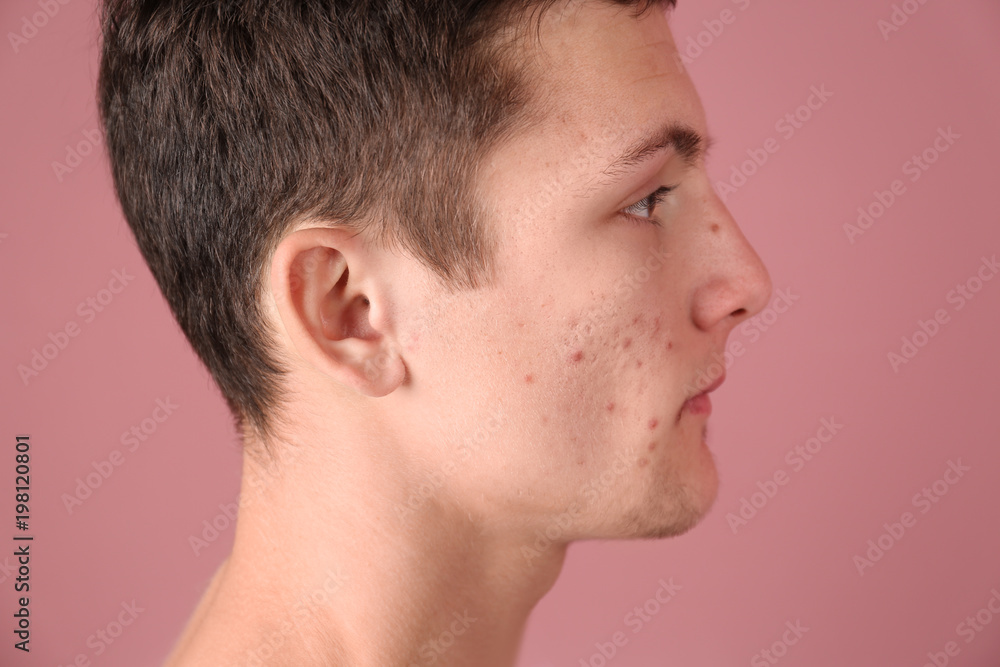 Fototapeta premium Young man with acne problem on color background