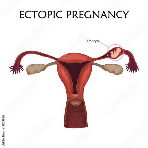 Ectopic pregnancy. Embrio, fetus in fallopian tube, uterus, womb. Anatomy illustration. White background. photo