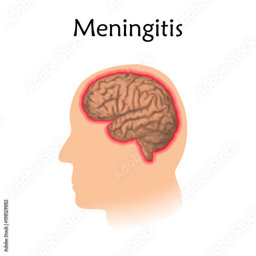 Meningitis. Vector medical illustration. White background, silhouette of head, anatomy image of brain.