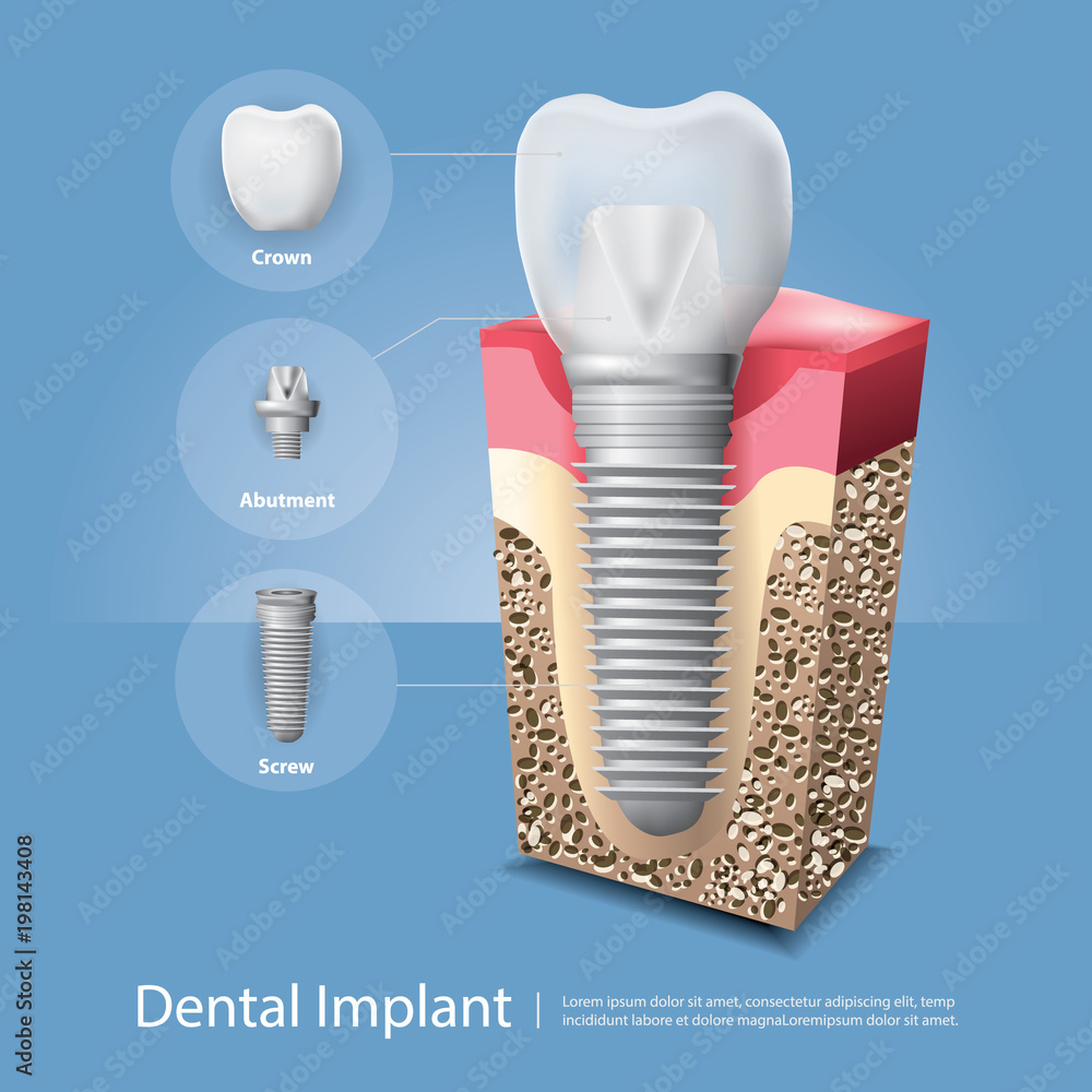 Obraz premium Human teeth and Dental implant Vector Illustration