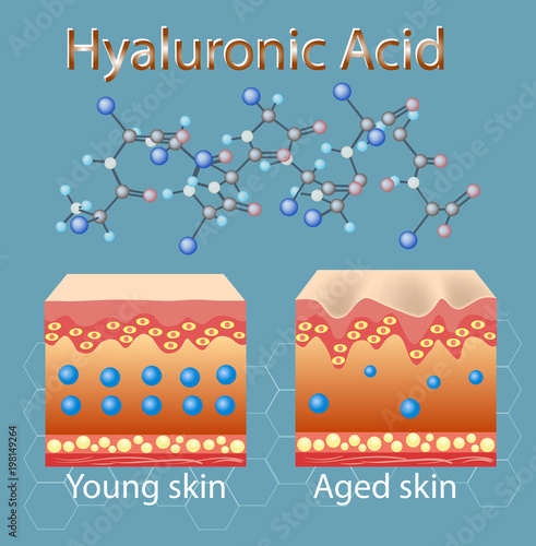 Vector illustration with process of getting skin old because of lack of hyaluronic acid