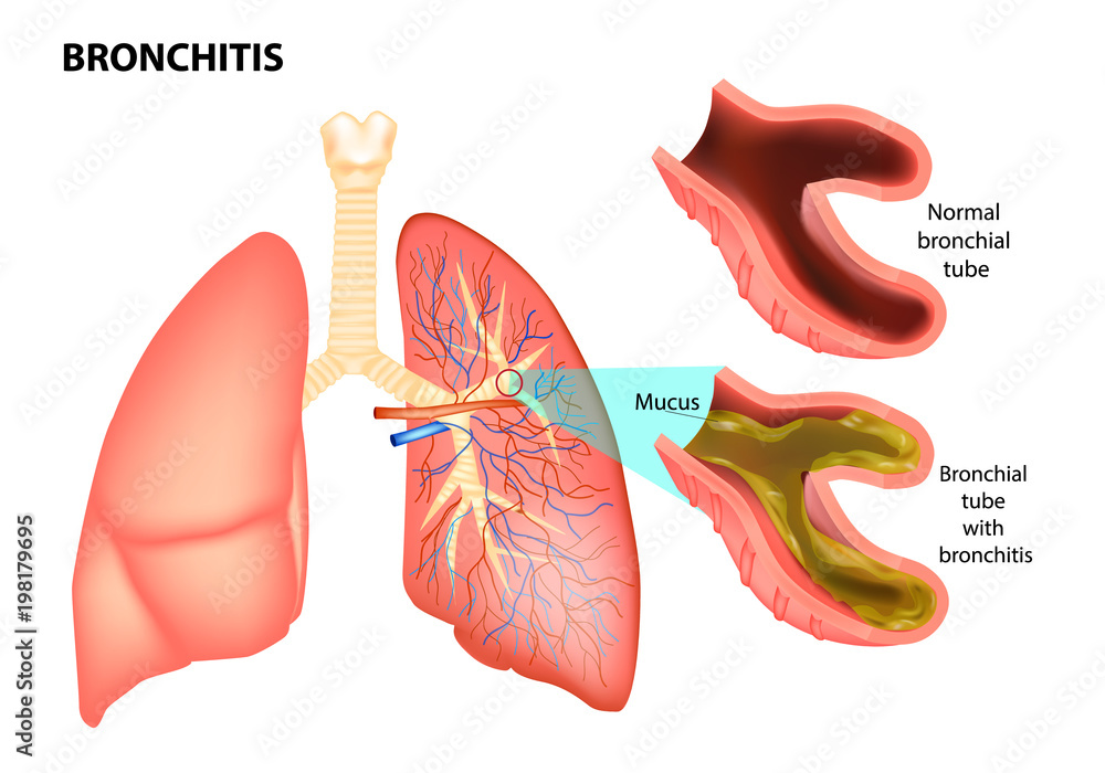 BRONCHITIS. Normal bronchial tube and Bronchial tube with bronchitis