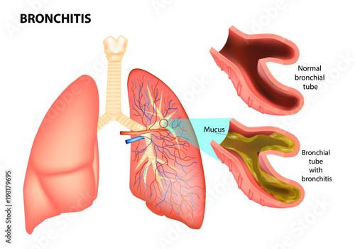 
BRONCHITIS. Normal bronchial tube and
Bronchial tube with bronchitis. Vector illustration of lungs affected by bronchitis photo
