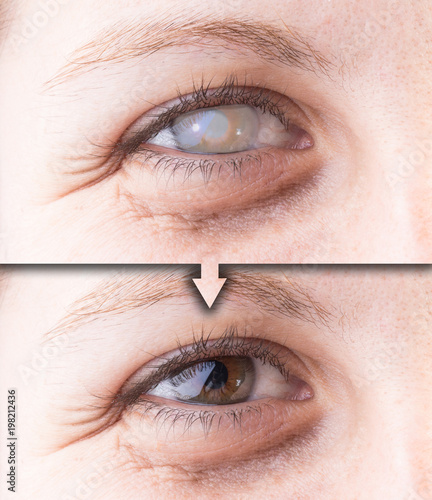 Eye with cataract and corneal opacity before and after surgery photo