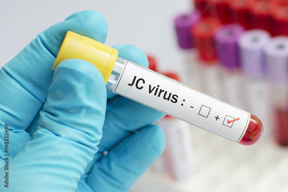 Fototapeta premium Blood sample positive with JC virus 