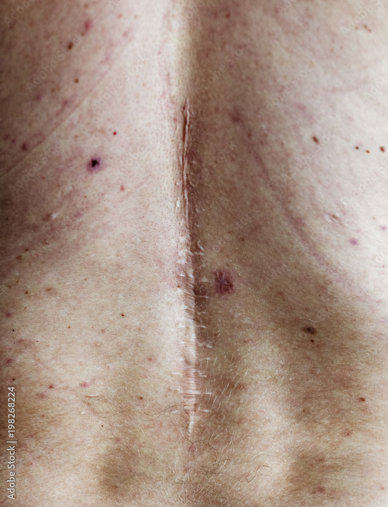 Fototapeta premium Elderly person back surgery scar