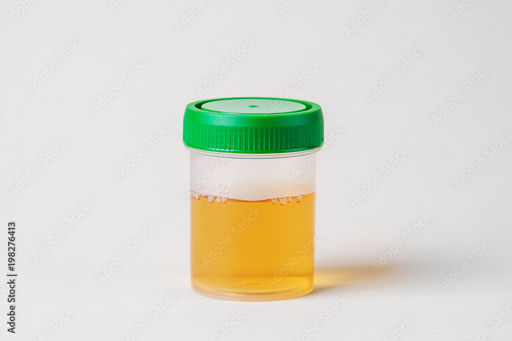 Laboratory analysis of urine for pregnant and diabetic patients. Urine