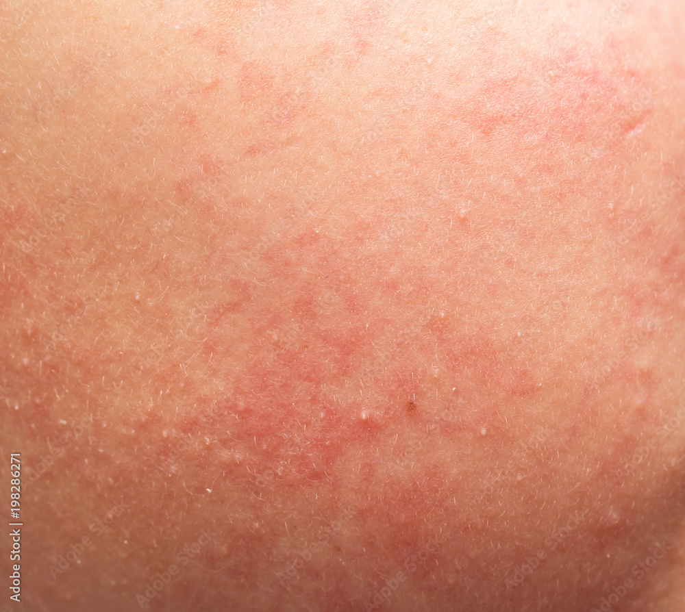 skin allergy in the form of rash