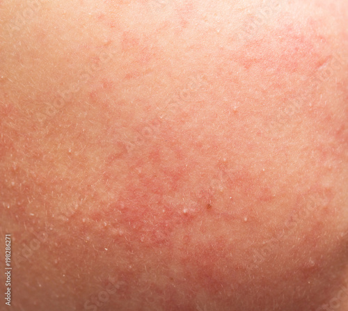 skin allergy in the form of rash