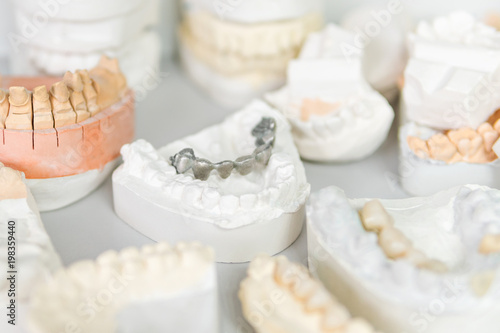 Metal prosthesis on plaster cast of human teeth