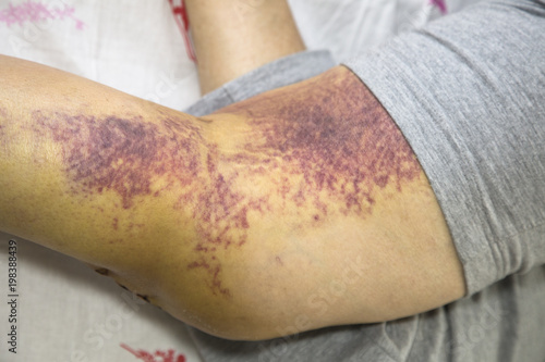 Patient month after surgery, long scar on knee Control of healing, clear the skin. Hospital health care. knee prosthesis postoperative