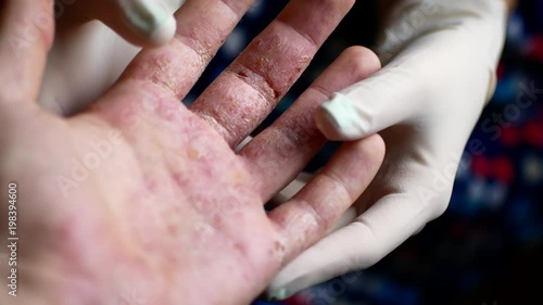 Doctor in gloves examines the hands of a man with psoriasis.