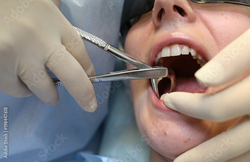 Tooth extraction in dentistry. photo