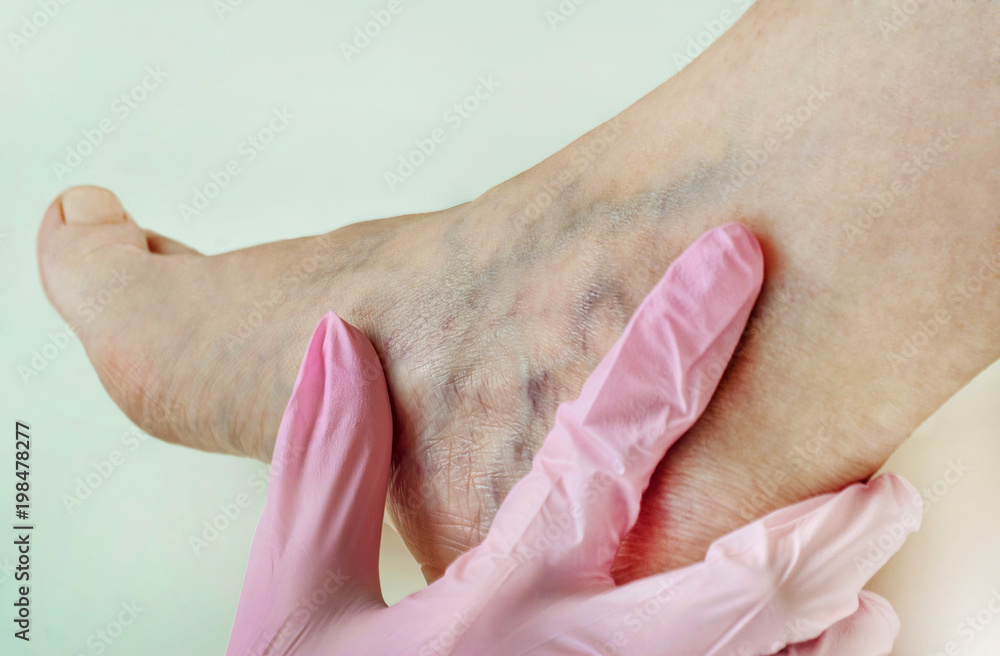 Naklejka premium Examination of varicose veins on the womans legs