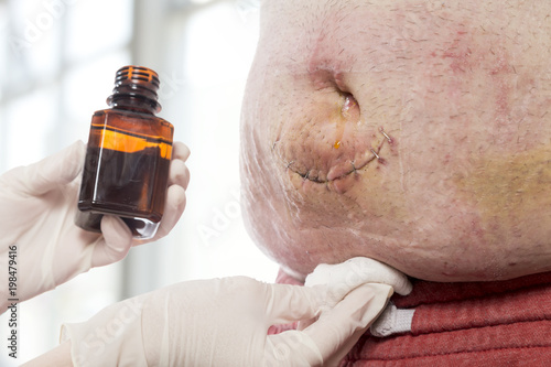 Nurse treating skin around the wound photo