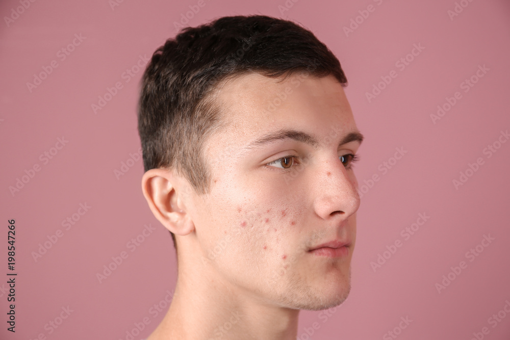 Naklejka premium Young man with acne problem on color background