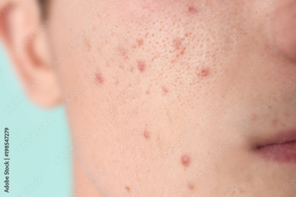 Young man with acne problem, closeup Young man with acne problem, closeup